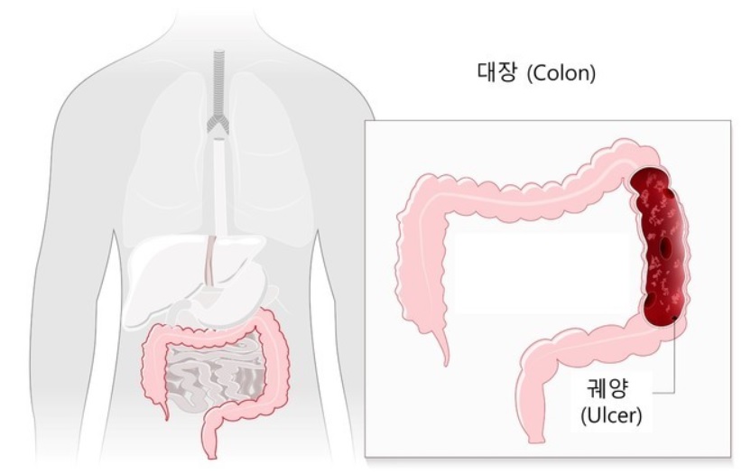 [서울=뉴시스]궤양성 대장염은 생명에 큰 지장은 없지만 완치가 거의 불가능하다. 특히 악화되면 대장암까지 유발할 수 있어 증상이 없어도 반드시 치료해야 한다. (사진= 서울대병원 제공) 2022.06.03