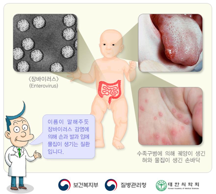 뉴시스] 수족구병(사진=질병관리청)